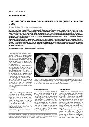 pictorial essay lung infection in radiology: a summary of ... - rbrs