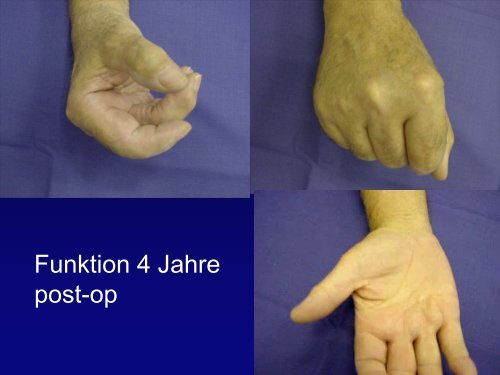 ACAMO-Fingermittelgelenk - G.-Wiehebrink