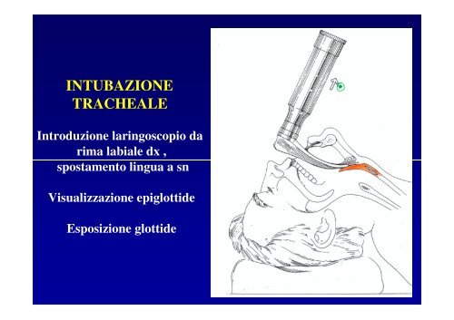 ANESTESIA GENERALE - Infermieristica Rimini