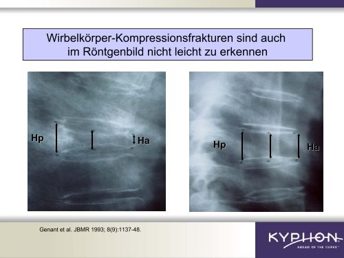 Osteoporose - Herz-Jesu-Krankenhaus Fulda