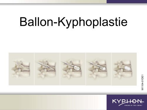 Ballon-Kyphoplastie - Herz-Jesu-Krankenhaus Fulda