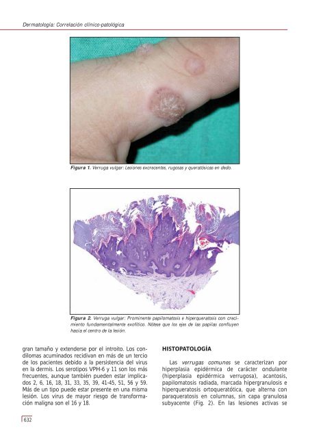 Tema 152 VERRUGAS VÍRICAS - e-dermatosis.com