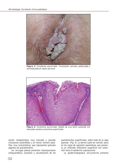 Tema 152 VERRUGAS VÍRICAS - e-dermatosis.com