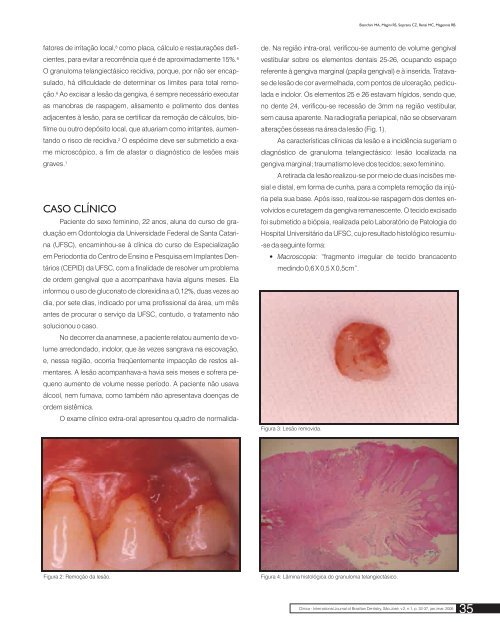 Granuloma Telangiectásico - CEPID - Universidade Federal de ...