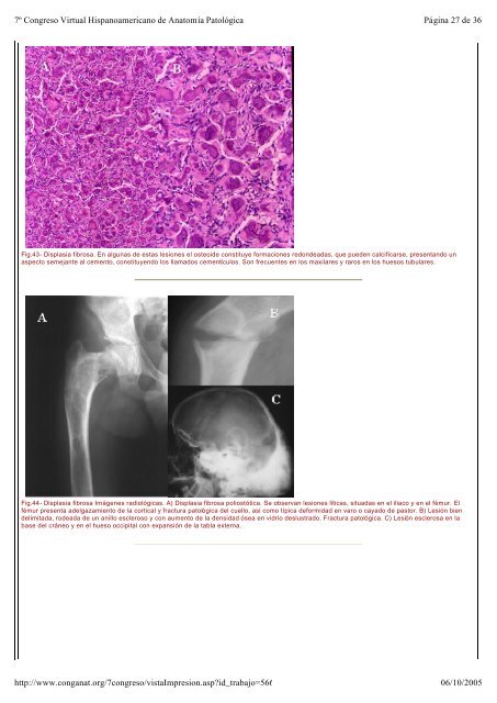 Diagnóstico diferencial de las lesiones de células gigantes de hueso