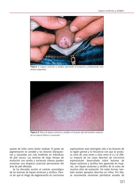 Liquen escleroso y atrofico.pdf - Webnode