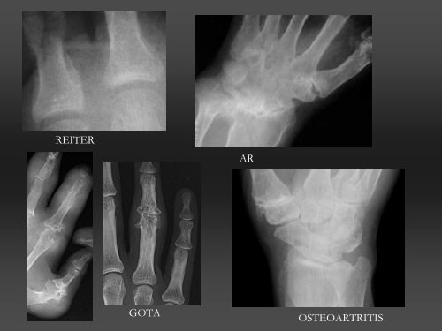 VALORACIÓN DE LA RADIOGRAFÍA DE LA MANO