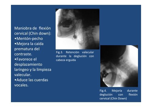 Maniobras de deglución asistida y estrategias ... - SORDIC