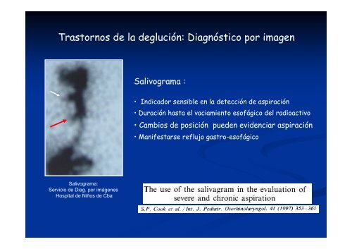 Síndrome aspirativo crónico