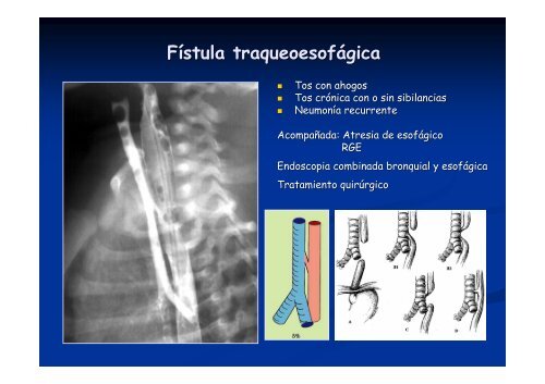 Síndrome aspirativo crónico