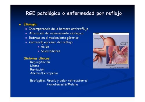 Síndrome aspirativo crónico