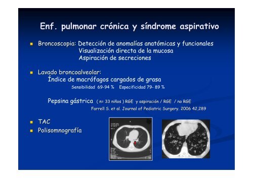 Síndrome aspirativo crónico