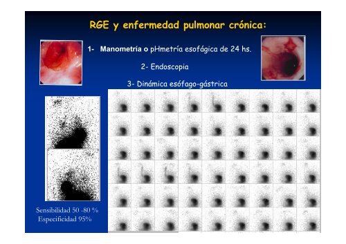 Síndrome aspirativo crónico