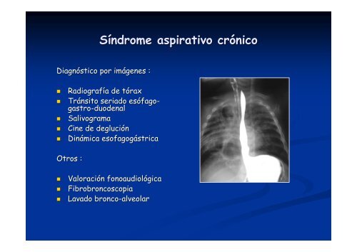 Síndrome aspirativo crónico