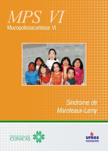 Síndrome de Maroteaux-Lamy - Rede MPS Brasil - Ufrgs