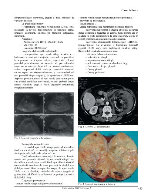 21 - simon - angiomiolip.indd - Clujul Medical - Iuliu Haţieganu