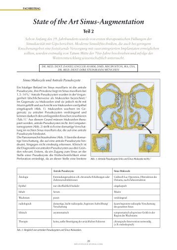 State of the Art Sinus-Augmentation - Fachpraxis Frauenplatz