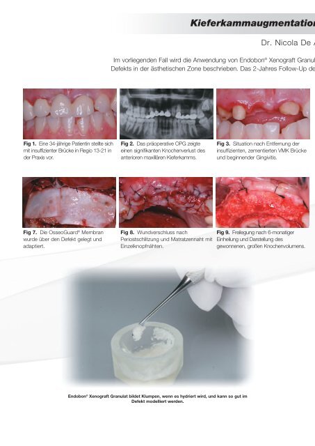 Endobon® Xenograft Granulat Bestellinformationen - BIOMET 3i