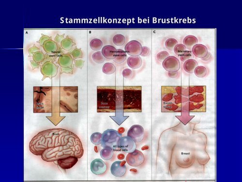 Stammzellkonzept und zielgerichtete Therapien bei Brustkrebs