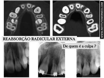 REABSORÇÃO RADICULAR EXTERNA De quem é a culpa ?