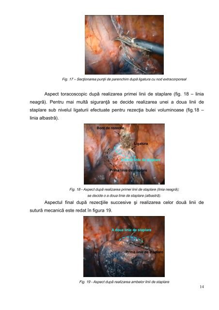 Toracoscopia diagnostică - indicaţii şi limite - Universitatea de ...