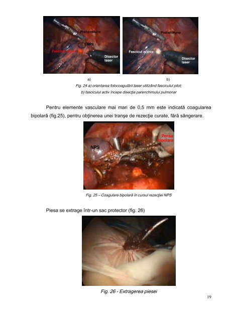 Toracoscopia diagnostică - indicaţii şi limite - Universitatea de ...