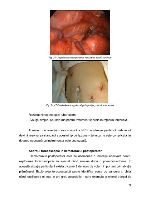 Toracoscopia diagnostică - indicaţii şi limite - Universitatea de ...