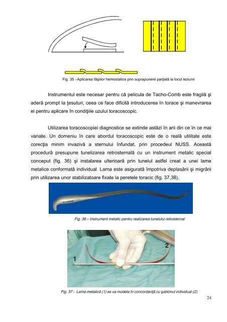 Toracoscopia diagnostică - indicaţii şi limite - Universitatea de ...