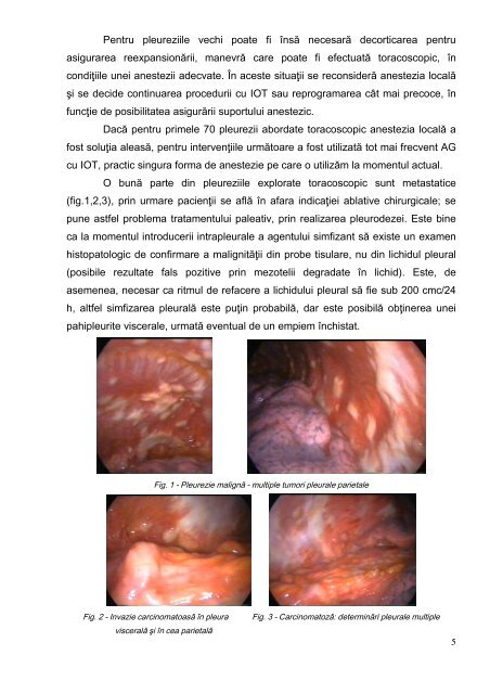 Toracoscopia diagnostică - indicaţii şi limite - Universitatea de ...