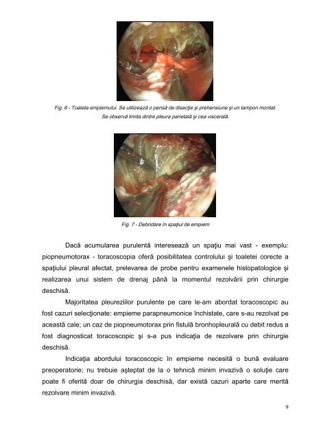 Toracoscopia diagnostică - indicaţii şi limite - Universitatea de ...