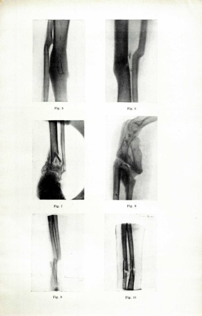 Seqüeles de les fractures complicades - Institut d'Estudis Catalans