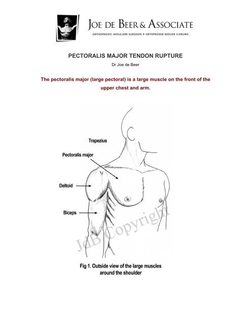 PECTORALIS MAJOR TENDON RUPTURE - Cape Shoulder Institute