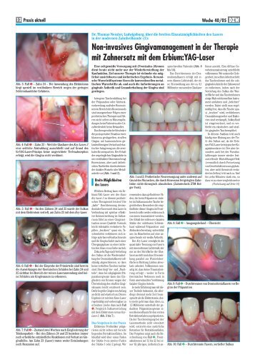 Non-invasives Gingivamanagement in der Therapie mit Zahnersatz ...
