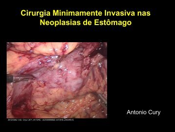 Videolaparoscopia para neoplasia gástrica. - IJP