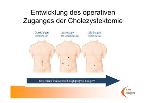 LESS Laparo-Endoskopic single site surgery - Kreiskrankenhaus ...