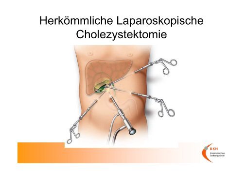 LESS Laparo-Endoskopic single site surgery - Kreiskrankenhaus ...