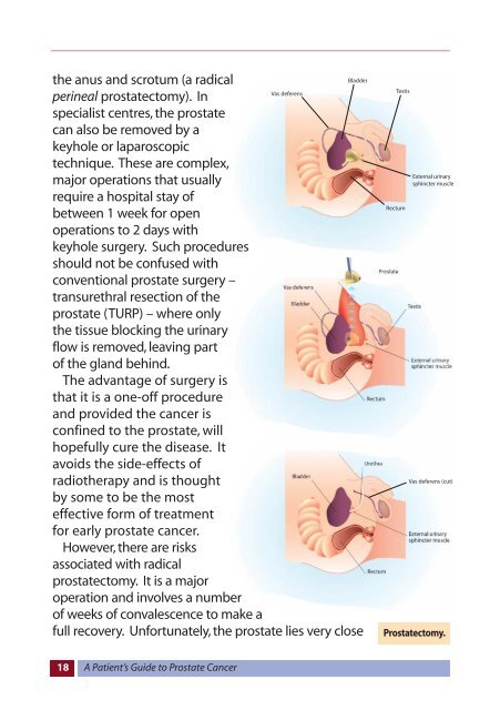 A Patient's Guide to Prostate Cancer - Prostate Cancer Centre