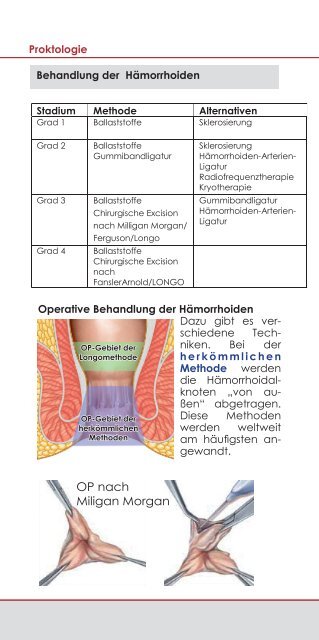 Proktologische (Enddarm) Erkrankungen Patienteninformation