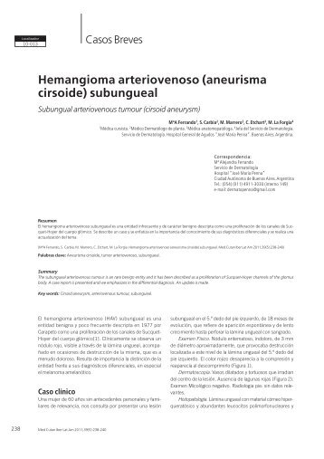 Hemangioma arteriovenoso (aneurisma cirsoide) subungueal