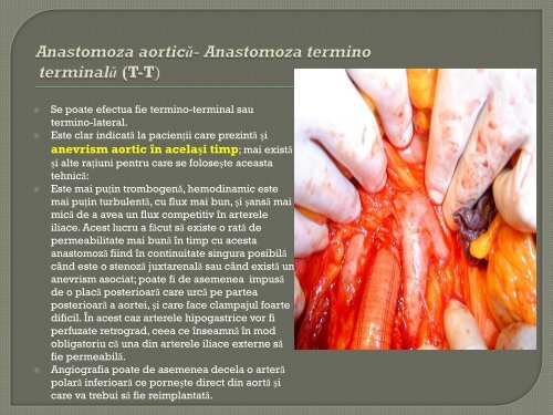 Chirurgia deschisa vs chirurgia - endovasculara - consideratii de baza