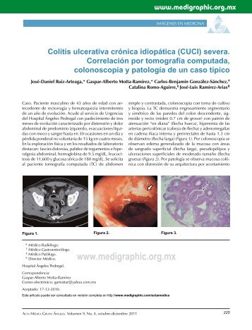 Colitis ulcerativa crónica idiopática (CUCI) severa ... - edigraphic.com