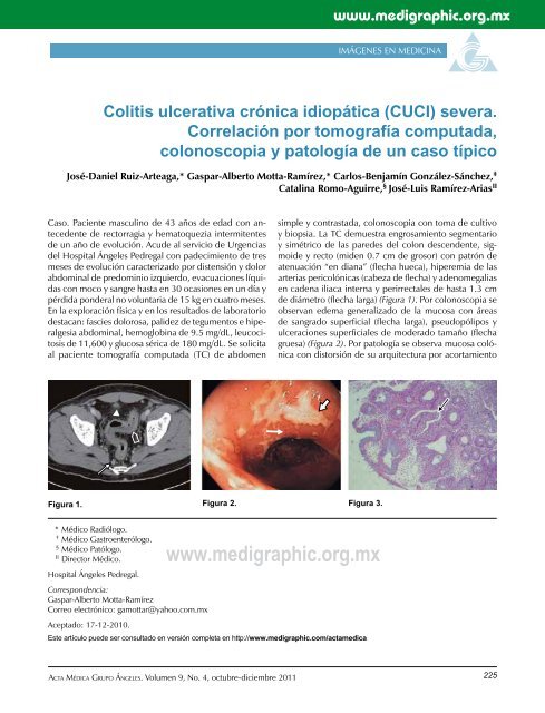 Colitis ulcerativa crónica idiopática (CUCI) severa ... - edigraphic.com