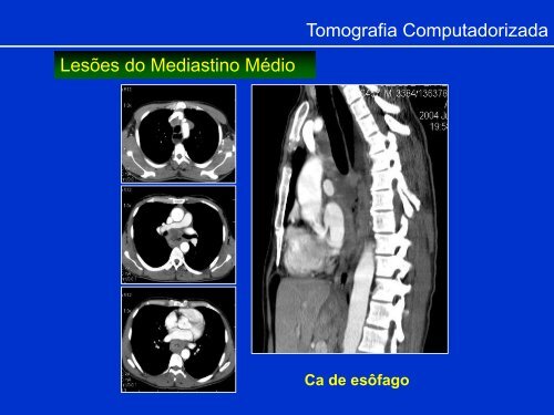 Métodos de Diagnóstico por Imagem aplicados ao Tórax