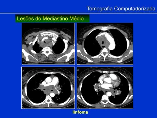 Métodos de Diagnóstico por Imagem aplicados ao Tórax