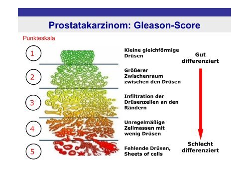 Klassifikationen und Scores in der Onkologie