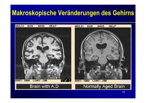 Therapie & Differentialdiagnose der Demenz