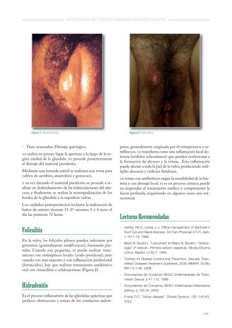 Que es foliculitis vulvar