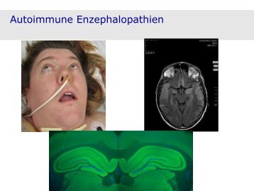Autoimmune Enzephalopathien