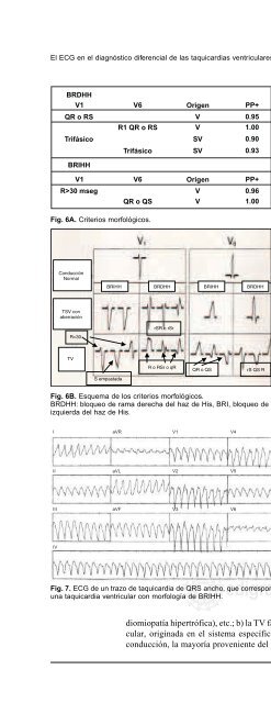 El electrocardiograma en el diagnóstico diferencial ... - edigraphic.com