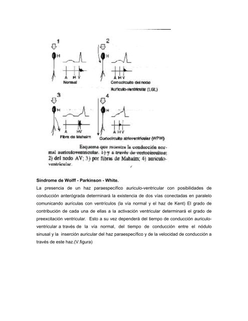 Arritmias